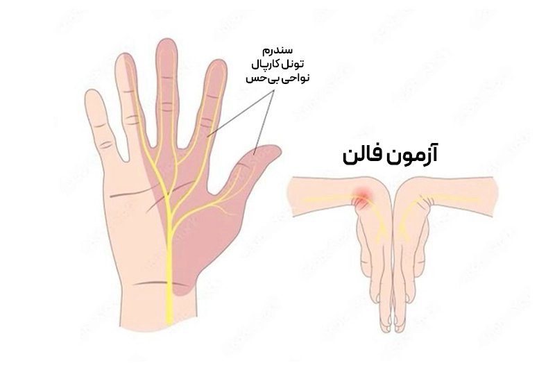 سندرم تونل کارپال چیست؟ تصویر تست فالن با دستهای خم شده و نواحی بیحس شامل شست، اشاره، میانی و نیمه انگشت حلقه.