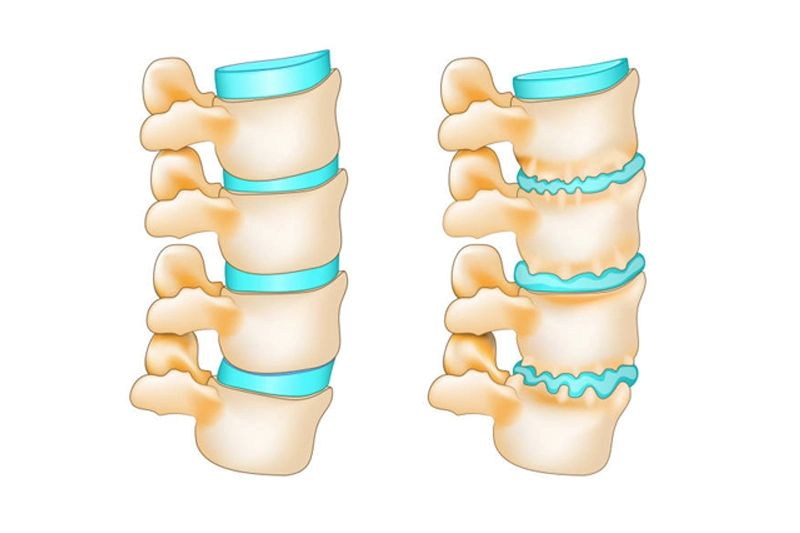 تصویر مقایسه‌ای از مفاصل و غضروف‌های گردن سالم و ناسالم مبتلا به ساییدگی (اسپوندیلوز گردنی)