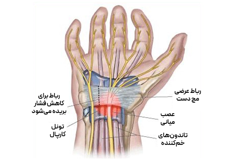 سندرم تونل کارپال چیست؟ تصویر عصب مدیان در ناحیه مچ و انگشتان، مسئول حس در شست، اشاره، میانی و نیمی از حلقه.