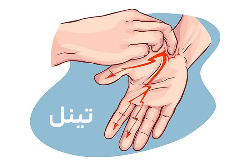 سندرم تونل کارپال چیست؟ نحوه انجام تست تینل با ضربه آرام روی عصب مدیان در مچ و حس سوزنسوزن شدن در انگشتان.