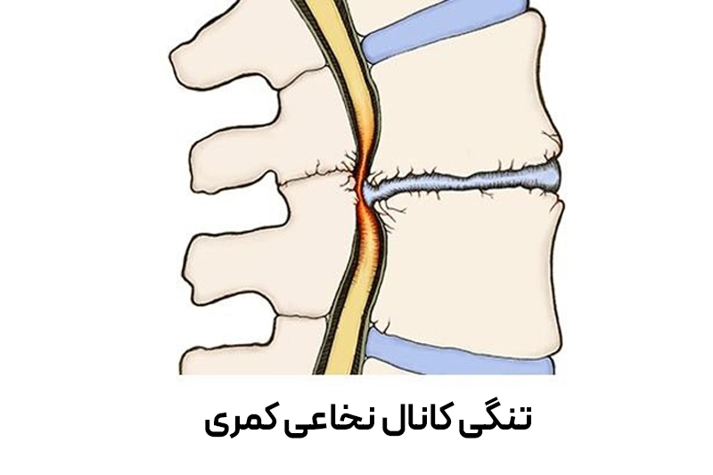 تصویر شماتیک از تنگ شدن کانال عصبی به دلیل خار استخوانی و فشار بر ریشه‌های عصبی.