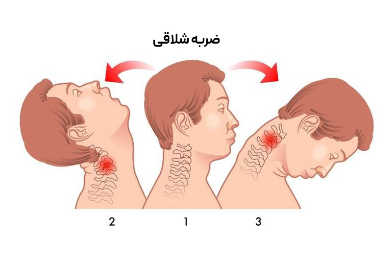 نمایش مراحل آسیب شلاقی گردن: از وضعیت طبیعی تا خم شدن شدید و فشار بر مهره‌ها .