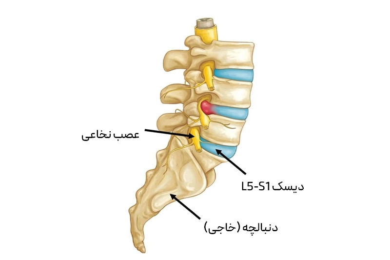 دیسکها پاره میشوند و به اعصاب فشار میآورند؛ باعث درد و بیحسی پاها میشود.