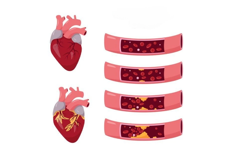 نمایش قلب و رگهای سالم و ناسالم، تأثیر دارچین در کاهش کلسترول و تریگلیسیرید