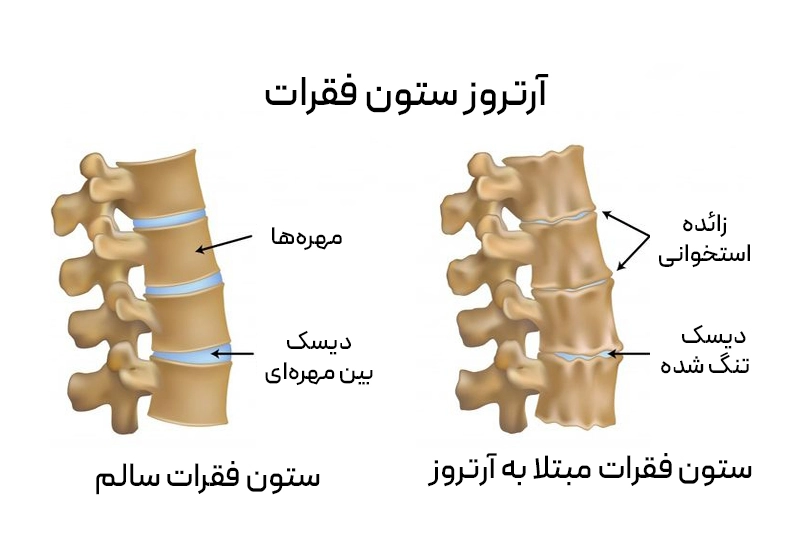 ساییدگی مفاصل فاست ستون فقرات با فرسایش غضروفها باعث درد، سفتی و کاهش حرکت میشود.