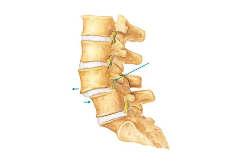 لغزش مهرههای کمر به جلو باعث فشار روی عصبها و درد در کمر و پا میشود؛ ناشی از ضعف عضلانی و وضعیت بدنی نادرست است.
