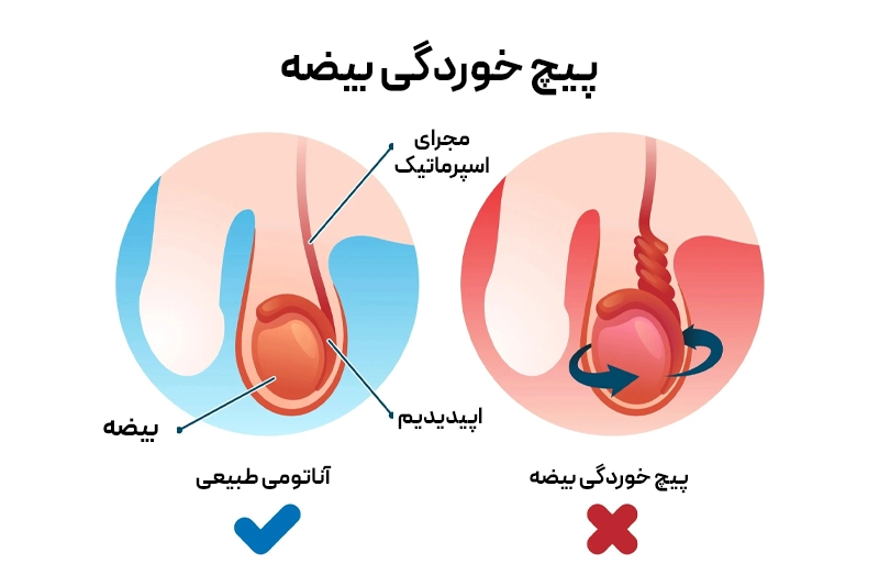 بیضه طبیعی و پیچخوردگی بیضه که باعث درد ناگهانی با انتشار به شکم و کمر میشود