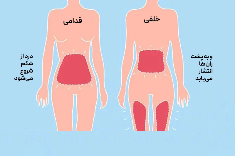 محل انواع دردهای قاعدگی روی بدن زن؛ دیسمنوره اولیه با درد طبیعی پریود و دیسمنوره ثانویه ناشی از بیماری