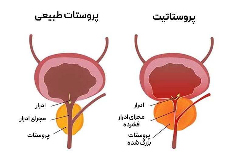 نمایش پروستات طبیعی و پروستاتیت که با التهاب غده پروستات موجب کمردرد، درد لگن و کشاله ران همراه با علائم ادراری میشود