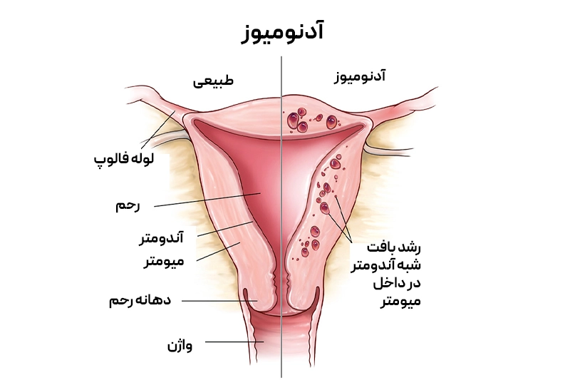 نمایش آدنومیوز؛ رشد بافت اندومتر داخل دیواره رحم که موجب بزرگ شدن رحم و کمردرد پس از پریود میشود