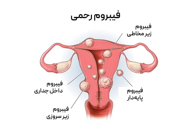 نمایش فیبرومهای رحمی؛ تودههای غیرسرطانی که با فشار بر اعصاب لگن و ستون فقرات موجب کمردرد و علائم دیگر میشوند