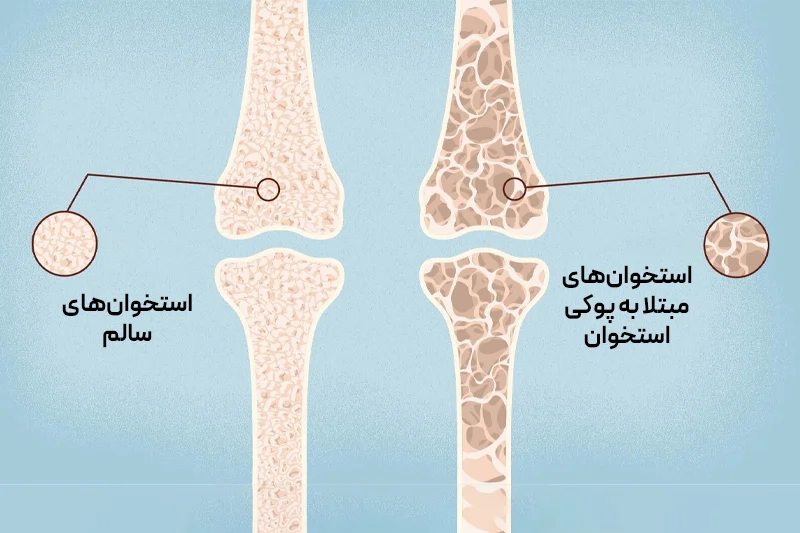 استخوان سالم و مبتلا به پوکی استخوان؛ کاهش تراکم پس از یائسگی مهرهها را شکننده و فشار جزئی باعث کمردرد میشود