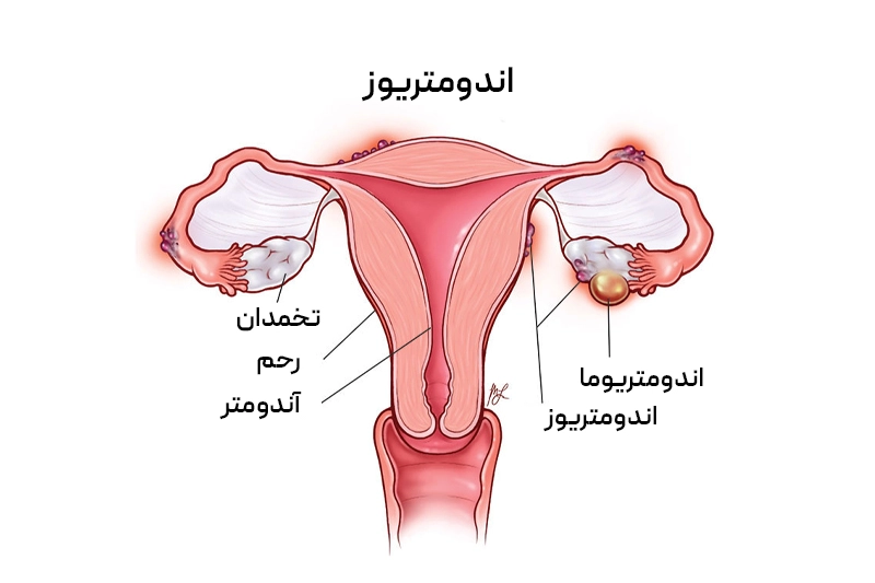 نمایش اندومتریوز به عنوان علت شایع کمردرد پس از پریود، با رشد بافت اندومتر خارج از رحم