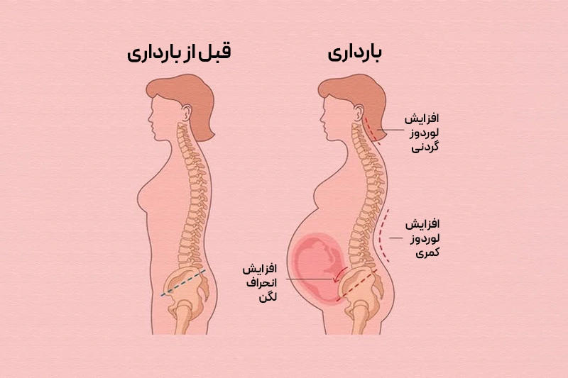 کایروپراکتیک در بارداری نمایش افزایش لوردوز کمر در بارداری و فشار بر اعصاب که باعث درد سیاتیک میشود