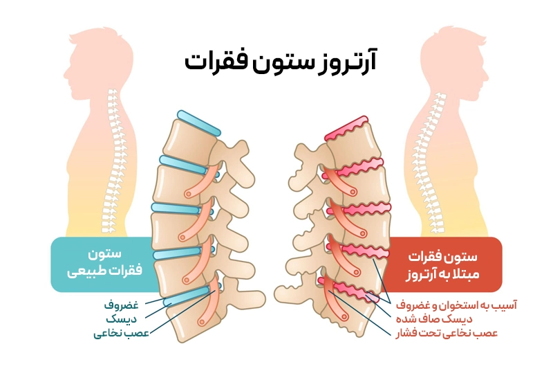 ستون فقرات سالم در مقایسه با آرتروز که موجب فرسایش غضروف، درد، سفتی و خار استخوانی میشود