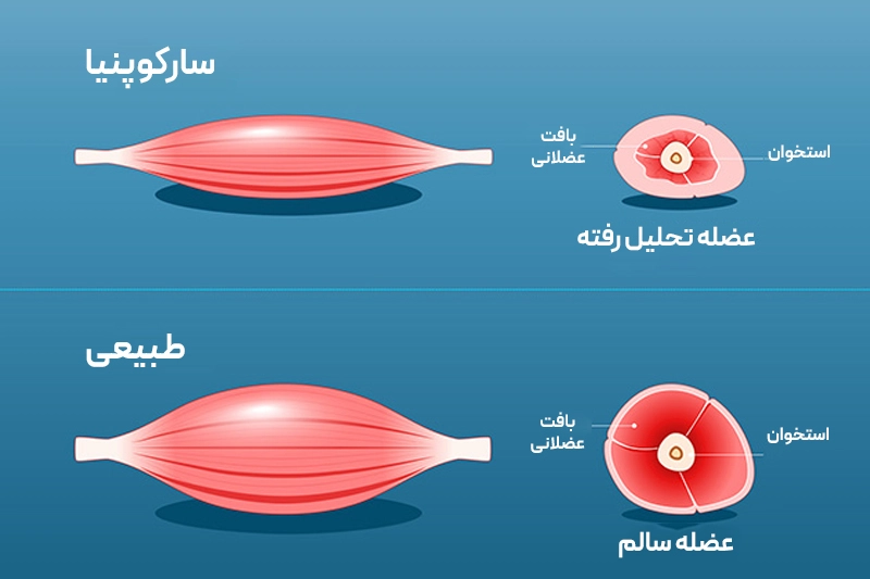 نمایش عضلات طبیعی و سارکوپنی؛ کاهش توده و قدرت عضلانی با سن و یائسگی حمایت ستون فقرات را کاهش میدهد