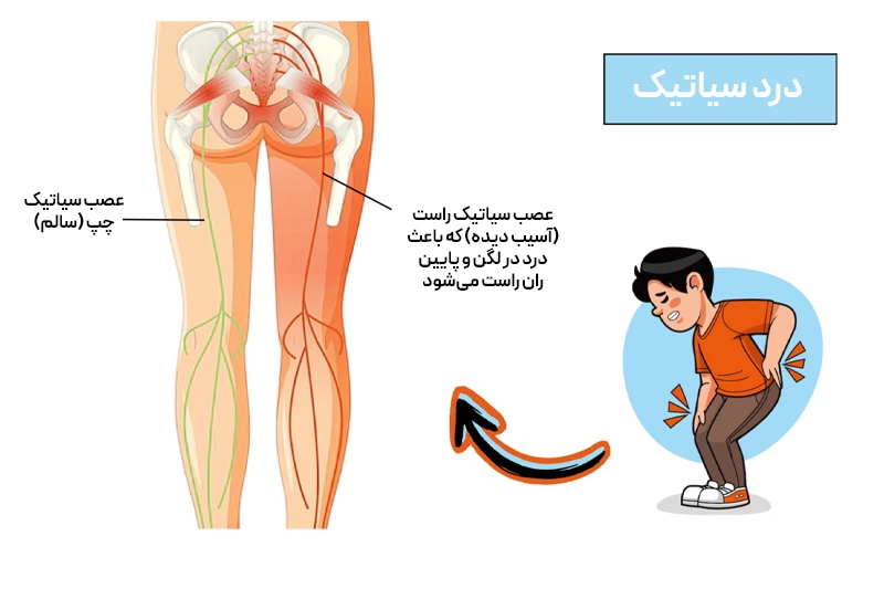 مسیر عصب سیاتیک از پایین کمر تا انتهای پا، که فشار دیسک یا خار استخوانی باعث درد تیز و سوزاننده میشود