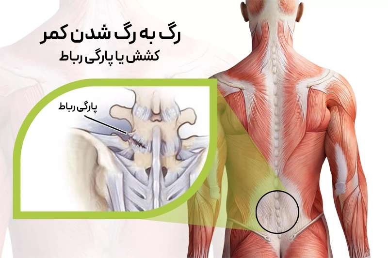 نمایش رباط پاره شده در پشت مرد به دلیل خستگی و کشیدگی عضلات