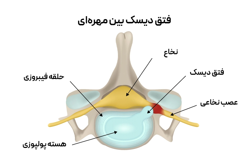نمایش دیسک ستون فقرات از زاویه بالا؛ فتق دیسک با پارگی و نشت هسته ژلهای باعث فشار روی عصب و درد سیاتیک میشود