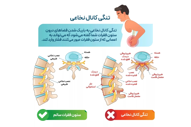 ستون فقرات طبیعی و ستون فقرات با تنگی کانال نخاعی که باعث فشار روی عصبها و لنگش نوروژنیک میشود